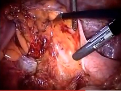 S vari bağırsağın divertikuliti zamanı laparoskopik siqmoidektomiya