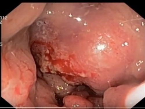 Yoğun bağırsağın polipozunun endoskopik görüntüsü